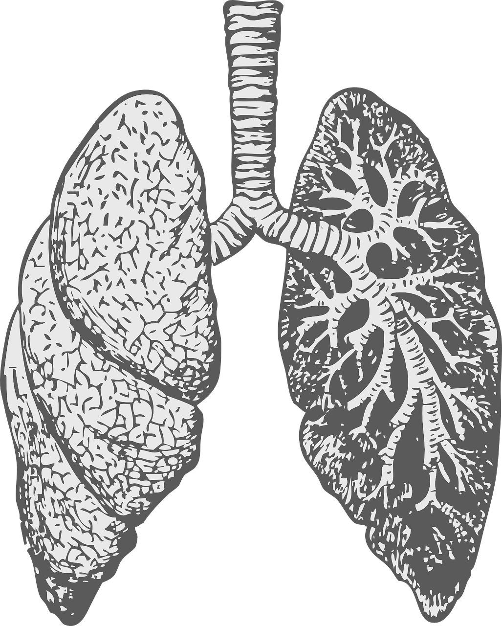 What is bronchiectasis? - Air Physiotherapy